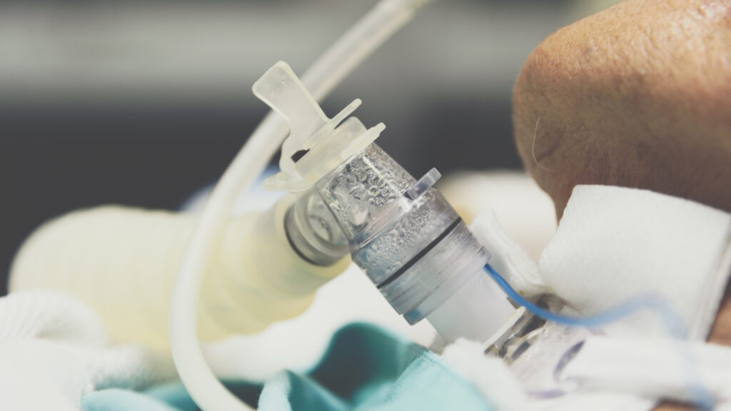 Äldre
  asiatisk patient i 80-årsåldern genomgår trakeostomi och använder respirator
  för andningshjälp vid luftvägshantering på sjukhus